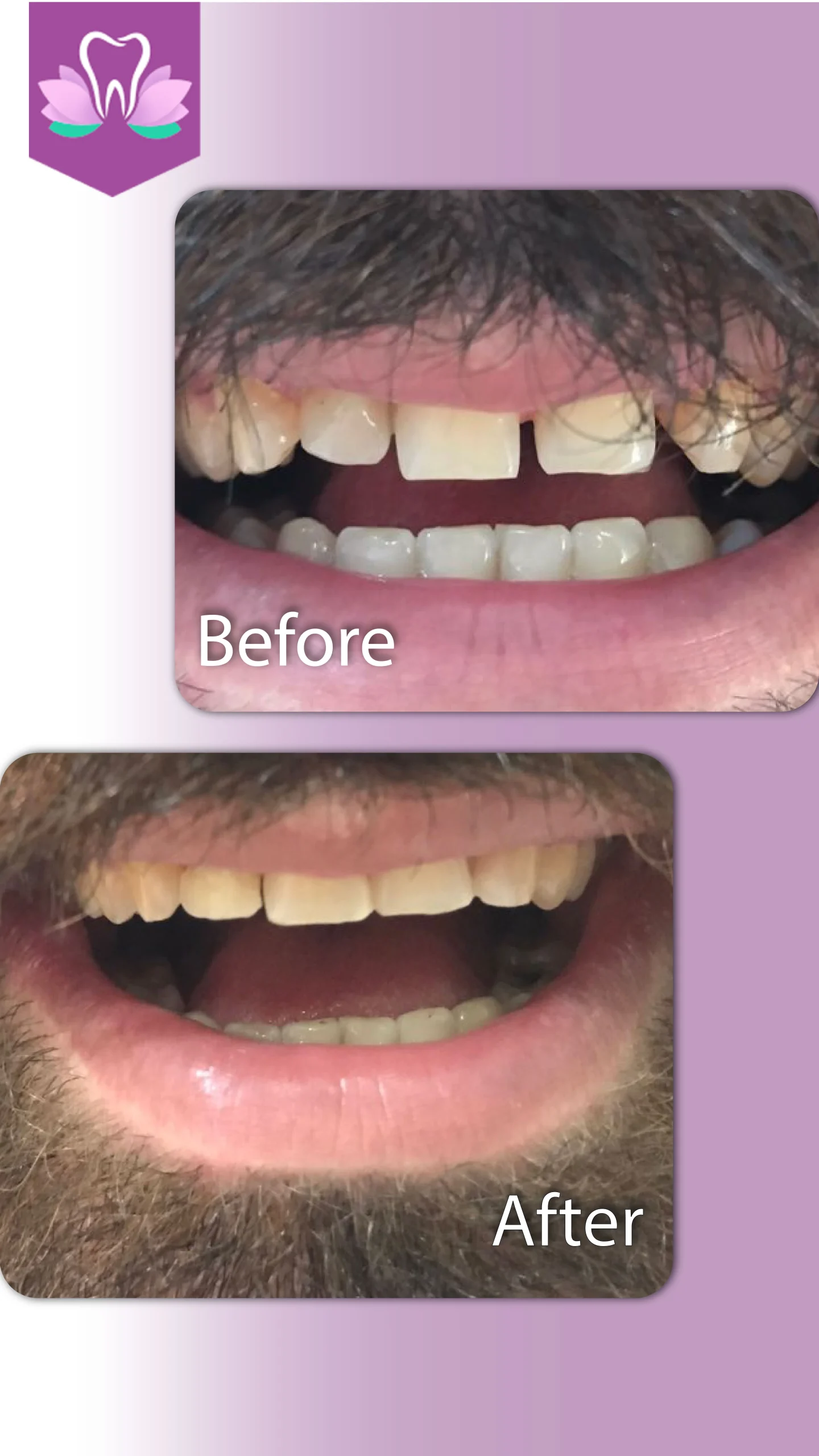 اصلاح فاصله بین دندانی