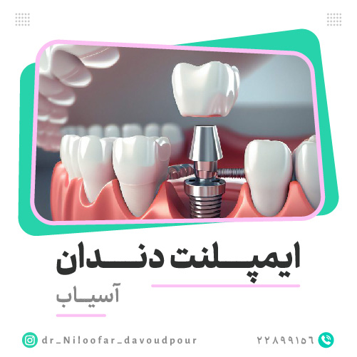 ایمپلنت دندان آسیاب؛ مراحل و مراقبت‌ها