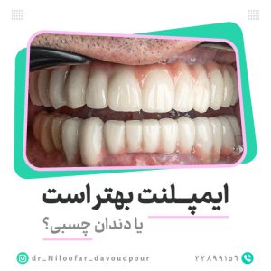 مقایسه ایمپلنت با دندان چسبی
